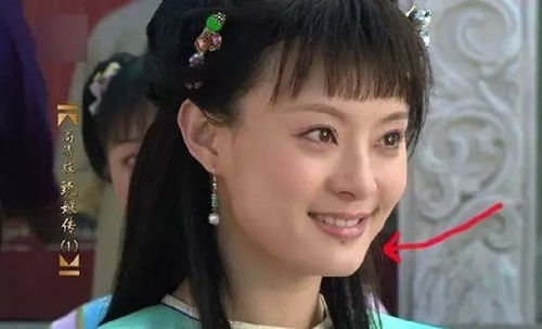 孙俪唇下痣系因车祸玻璃碴致假性痣