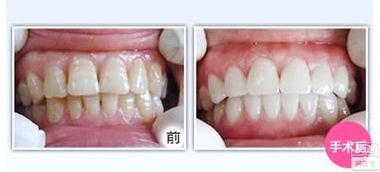 汽车抛光牙齿价格多少
